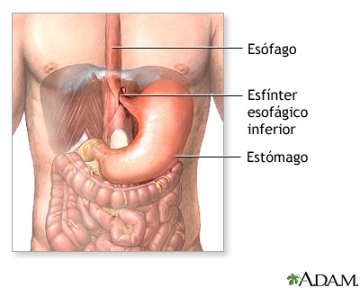 reflujo esofágico NO HAY EXCUSAS